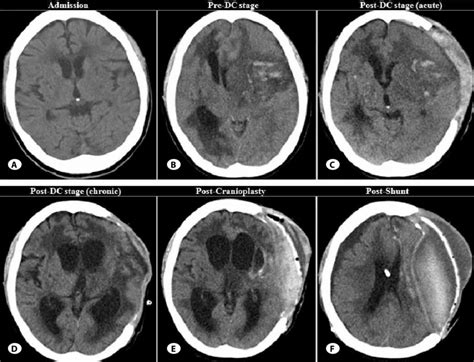 test tears for csf|ct scan for csf.